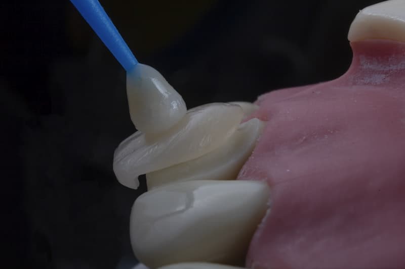 Complete Guide to Dental Implants