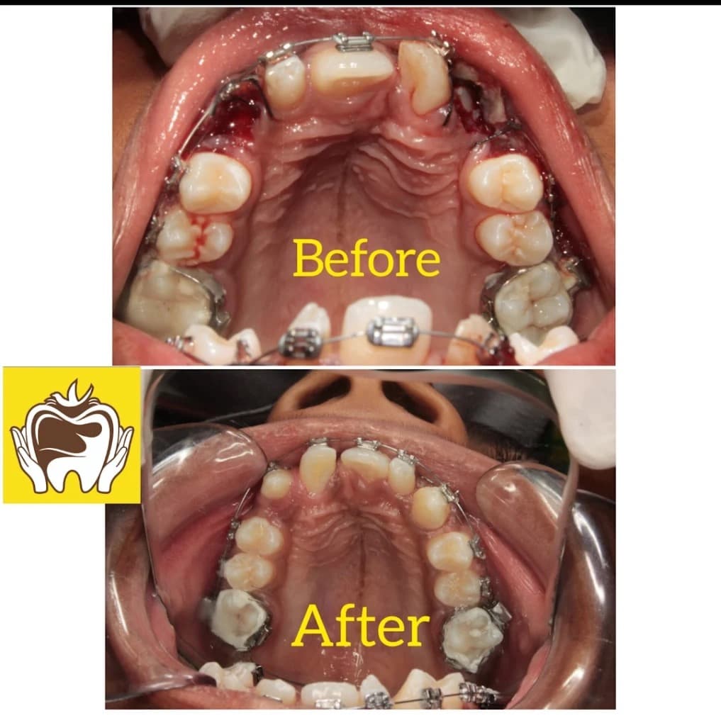 Orthodontic braces treatment results