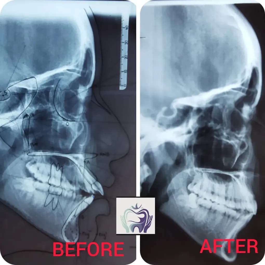 Jaw alignment treatment results