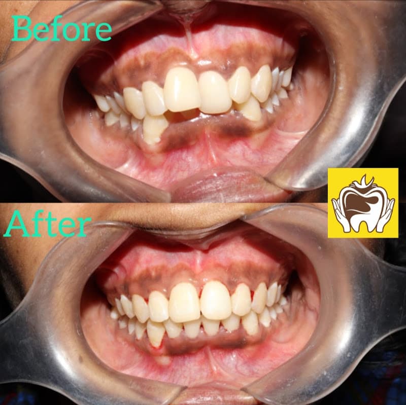 Teeth alignment before and after treatment