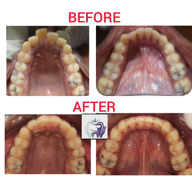 Upper and lower arch alignment results